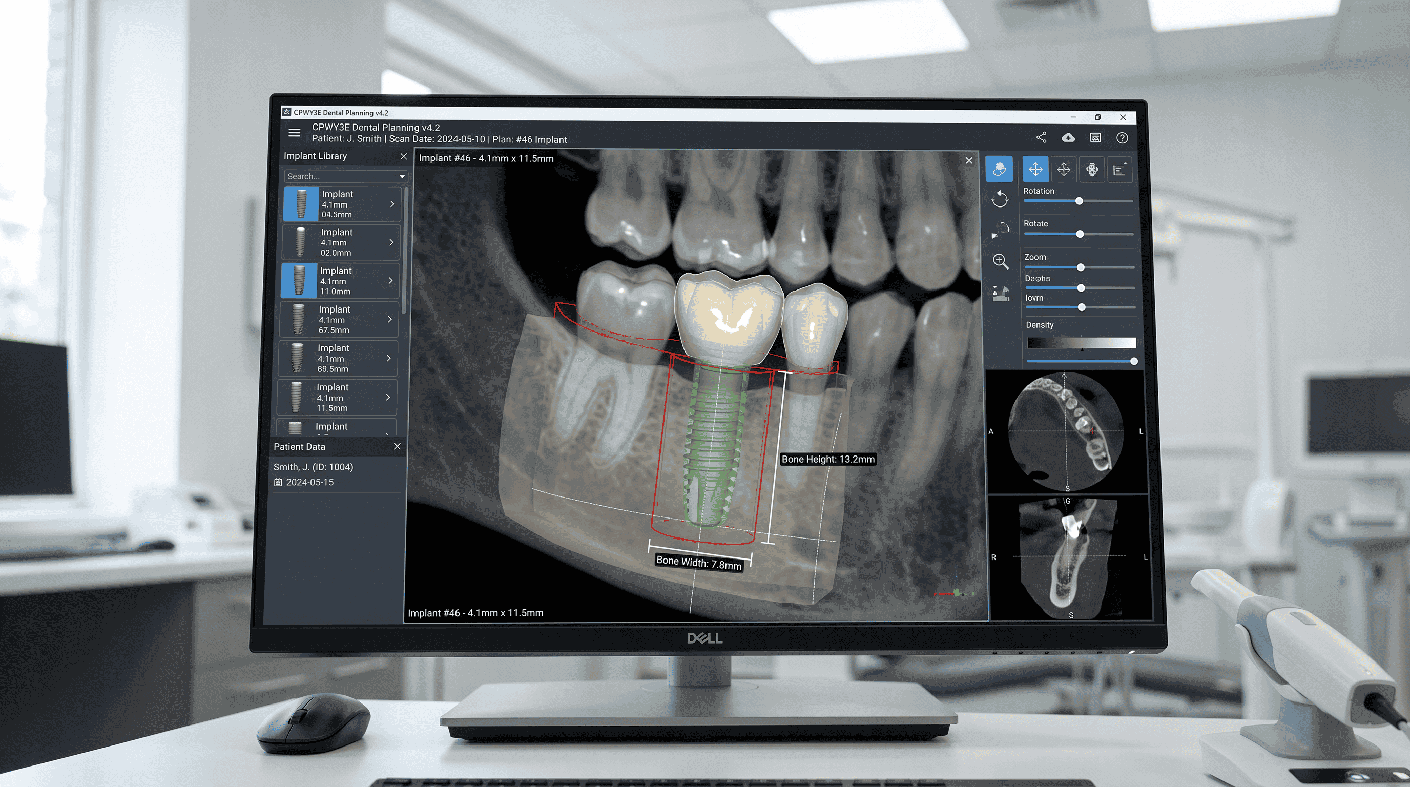 Guided Implant Surgery in clinic